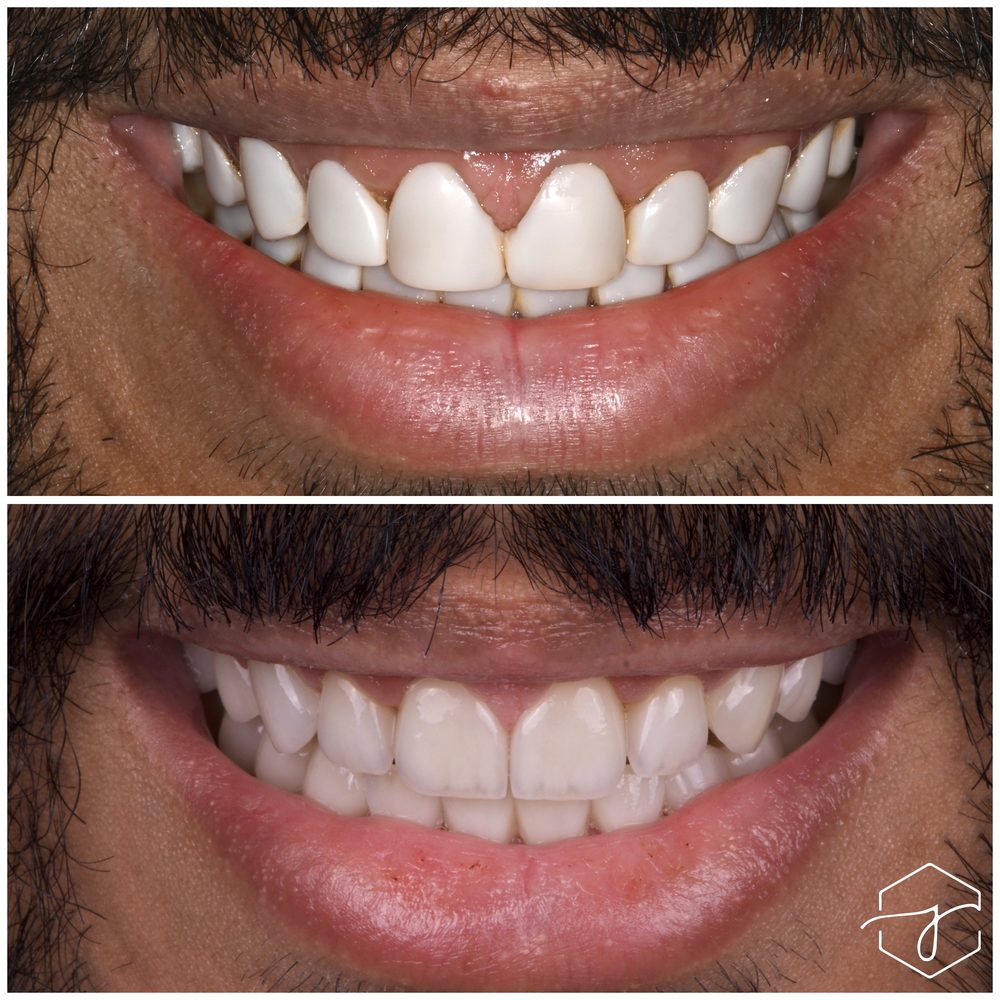 قبل وبعد - حالة تجميل الابتسامة 12